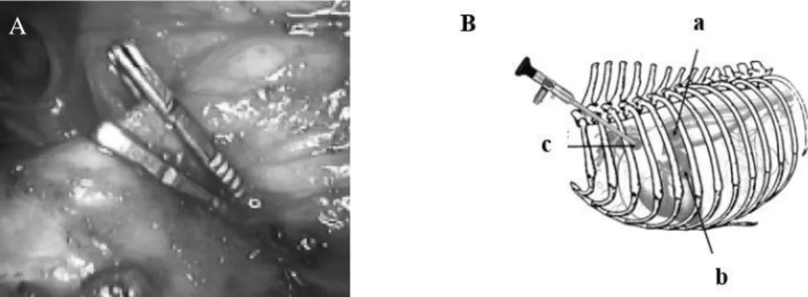 Figura 7 - Vista  intratorácica  do  CA  após  encerramento  por  dois  clips  hemostáticos  através  de  toracoscopia  (A)  e  representação  esquemática  dos  locais  de  acesso  para  a  realização  da  toracoscopia (B): (a) acesso pelo 5º espaço interc