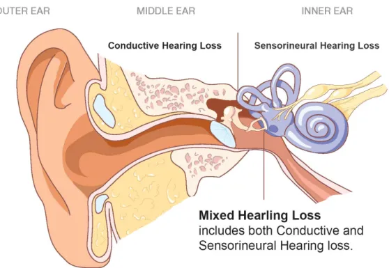 Figure 1.3-9 – Anatomic ear representing the different types and affected regions on hearing loss