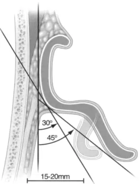 Figura 1 – O ângulo auriculocefálicoé definido como a relação entre o plano da  mastoide e uma linha entre a raiz helicoidal e a borda lateral da hélice 