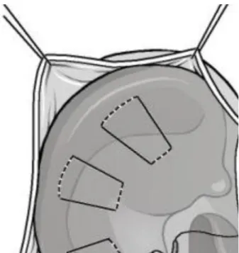 Figura 3 - Correção da anti-hélice por técnica de sutura de Mustardé 