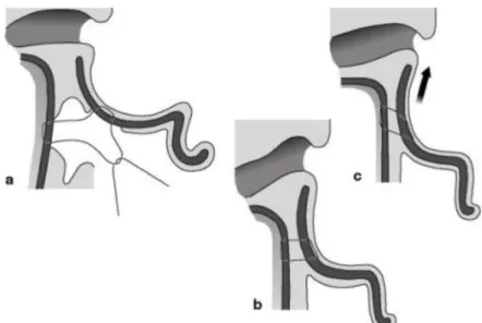 Figura 4 - Correção da concha auricular com rotação da conchapor meio da técnica  de Furnas 