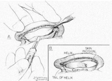 Figura 6 -Correção do posicionamento do lóbulo da orelha por meio do controle da  cauda da hélice 