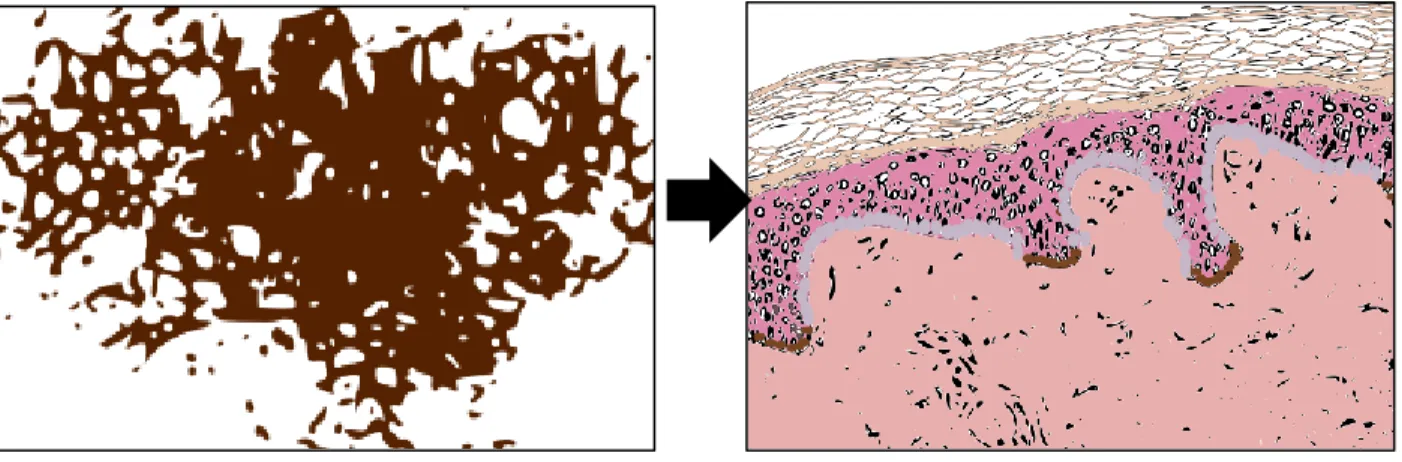 Figura  3.  O  achado  de  rede  na  dermatoscopia  e  seu  correspondente  histopatológico