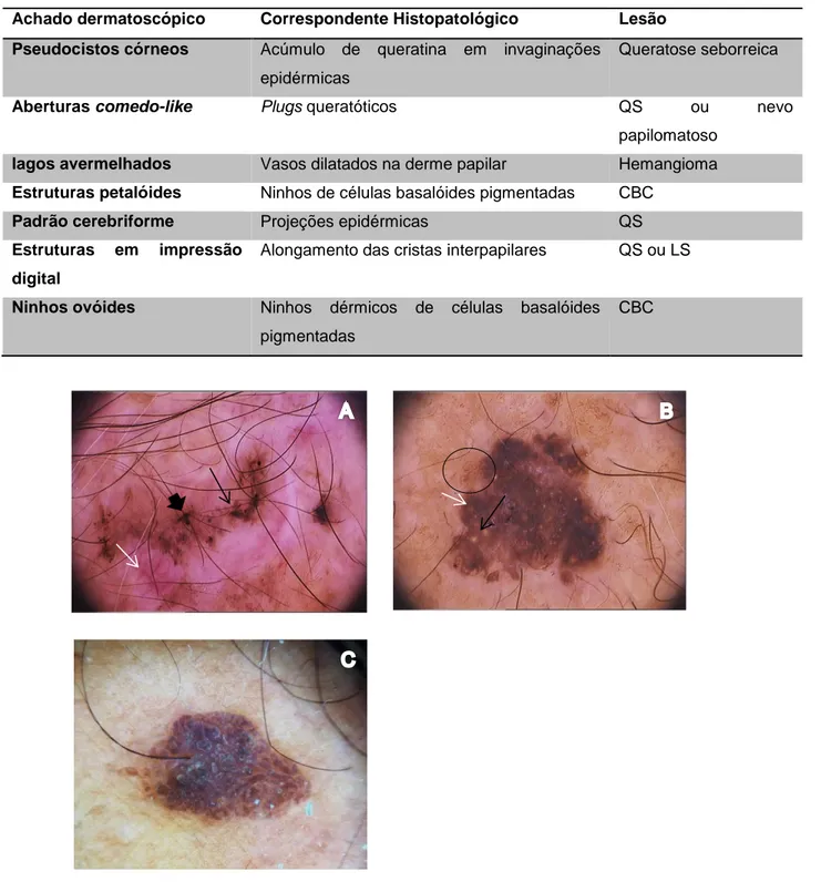 Tabela 2. Achados dermatoscópicos de lesões não melanocíticas (12,16,17) 