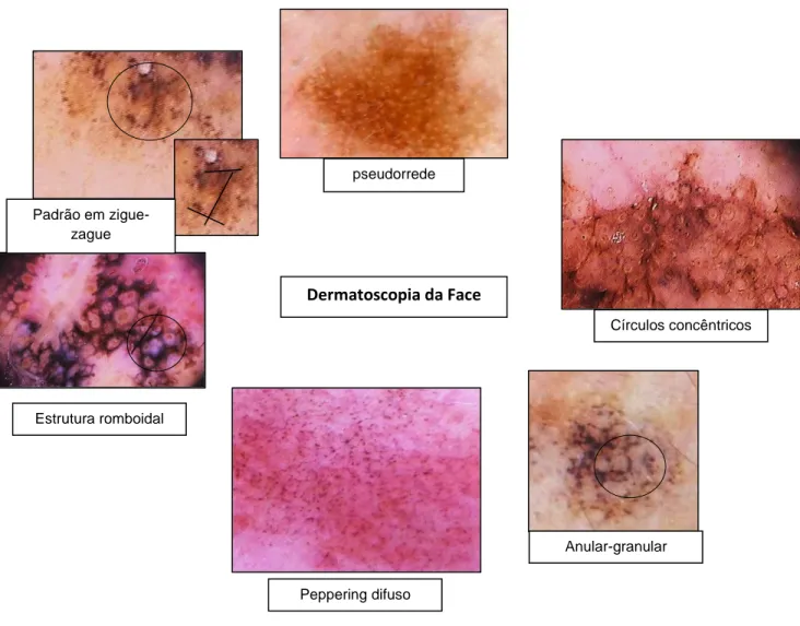 Figura 7. Achados frequentes na dermatoscopia da face. 