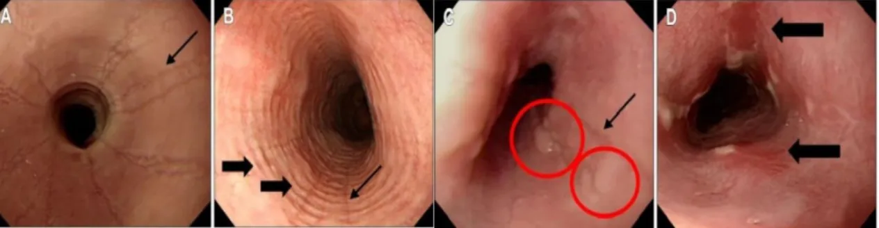 Figura 2. Alterações na EDA. Apresentam-se alguns dos achados num doente com EoE, nomeadamente  (A) estrias lineares, (B) estrias lineares (seta fina) e anéis concêntricos (setas grossas), (C) estrias lineares  (seta)  e  nódulos  (círculos),  e  (D)  lace