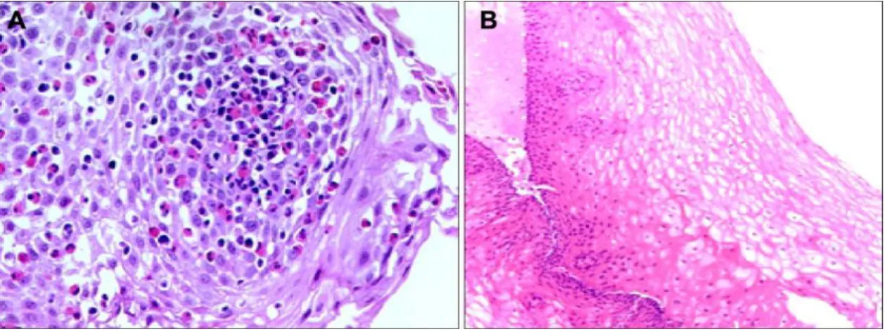 Figura  4.  Aspeto  microscópico  da  mucosa  esofágica,  observado  através  da  coloração  de  hematoxilina- hematoxilina-eosina, apresentando: (A) infiltração eosinofílica significativa e (B) a mesma mucosa após instituição de  regime terapêutico com in