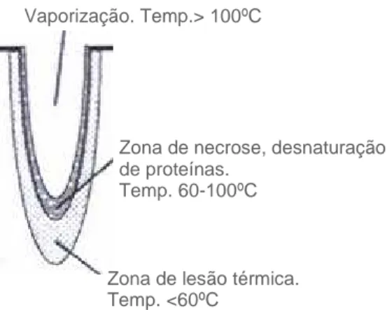 Figura  6.  Esquema  representativo  da  lesão  que  o  laser  provoca  nos  tecidos.  A  temperaturas  superiores  a  100ºC  ocorre  vaporização  dos  tecidos