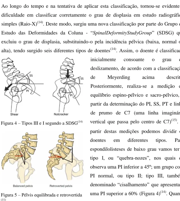 Figura 4 – Tipos III e I segundo a SDSG (14)