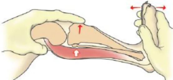 Figura  4.  Teste  de  compressão  tibial.  Segurar  o  quadríceps  distal  com  uma  mão,  a  partir  da  superfície  cranial,  para  que  o  dedo  indicador  possa  ser  estendido  para  baixo,  sobre  a  patela,  e  para  que  a  ponta do  dedo  esteja 