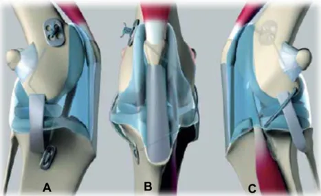 Figura  7.  Ilustração  medial  (A),  crânio-caudal  (B)  e  lateral  (C)  da  técnica  de  “TighRope” 