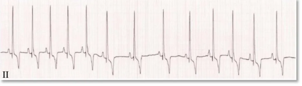 Figura 4 – Eletrocardiograma de um cão com uma persistência do canal arterial (adaptado  de Loureiro, 2014)