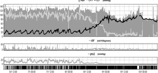 Figure 6: Multimodal brain monitoring documentation of the evolution to irreversible zero flow and brain death