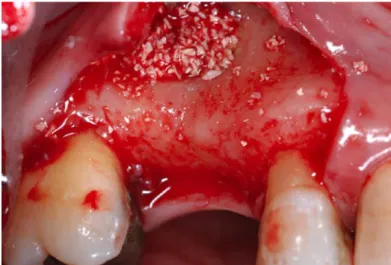 Fig. 20: Material de enxerto colocado no seio maxilar sem a presença dos implantes dentários  (grupo de tratamento 2 e 4) 