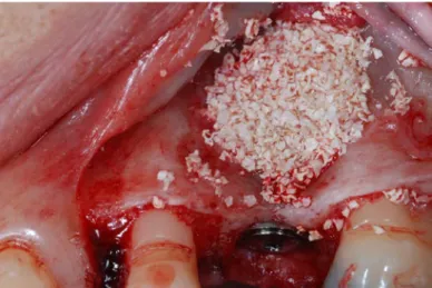 Fig. 22: Material de enxerto colocado no seio maxilar com a presença do implante dentário  (grupo de tratamento 1 e 3) 