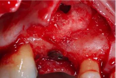 Fig. 29: Implante dentário colocado e loca deixada pela colheita de amostra do enxerto para  avaliação histológica 