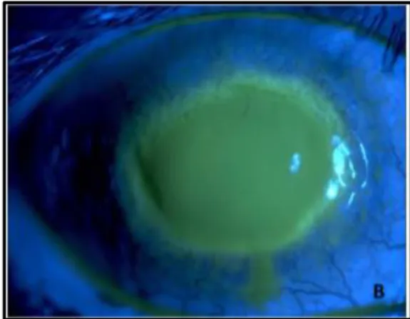 Figure 3. Corneal damage in AK shown after sodium fluorescein  application (adapted from (24))