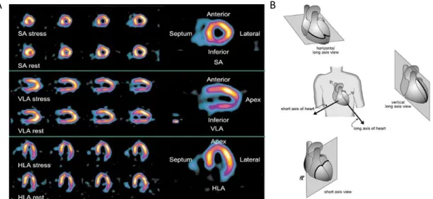 Fig.  2.7.A. Standard tomographic slices of  the heart representing the short axis (SA), the vertical long axis (VLA) and the  horizontal long axis (HLA) views of the heart 16 