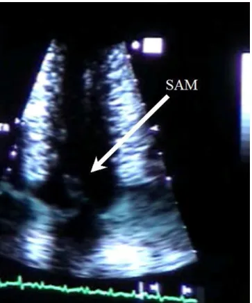 graphic data is presented in Table 1, details of the exercise test are depicted in Table 2, and details of echocardiogram in Table 3, 4, and 5.