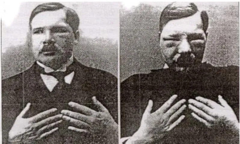 Figure  2.2  First  report  of  exogenous  porphyrin  photosensitisation.  In  1913,  after  injecting  himself  200mg of HpD,  Meyer-Betz noted severe pain  and swelling of the part of his body exposed to light,  showing  a  massive  phototoxic  reaction