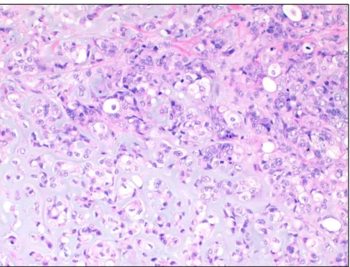 Figura 2 CMM: área de transição entre o componente epitelial (carcinoma pouco diferenciado) e  o componente mesenquimatoso (diferenciação condróide) 