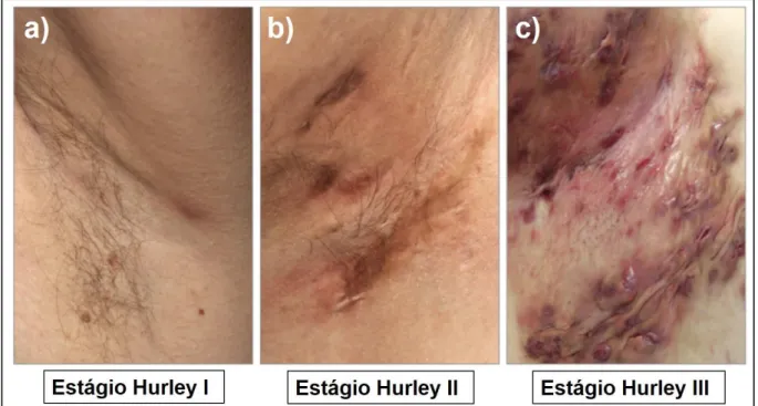 Figura  5.  Os  diferentes  estágios  de  Hurley.  Estágio  de Hurley  I  -  lesão  inflamada  sem  cicatrização  (a);  Estágio  de  Hurley  II  -  cicatrizes  e  nódulos  inflamados  separados  por  pele  clinicamente  não  afetada  (b)  e  Estágio  de  H