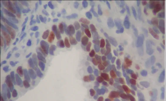 Figura 3. Fotomicrografia mostrando a detecção imuno-histoquímica  de Ki-67 em núcleos celulares de adenocarcinoma de colo uterino