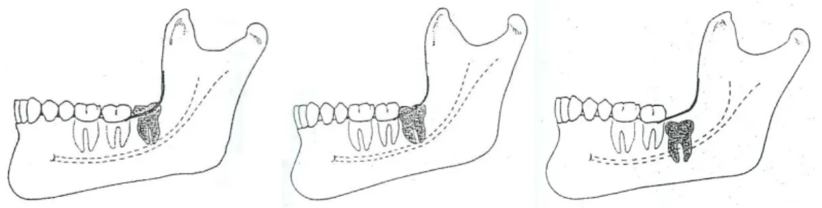 Figura 2  -  Classificação  da posição dos terceiros  molares  segundo  Pell  &amp;  Gregory  em  relação ao plano oclusal A, B e C, respectivamente (imagem adaptada de Peterson et al.,  2000)