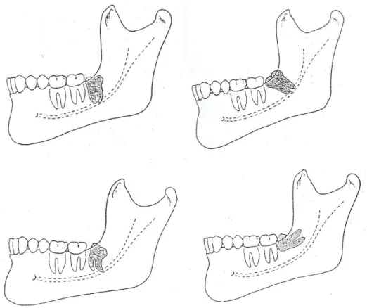 Figura 3 - Posição dos terceiros molares segundo a angulação: vertical, mesio-angular,  disto-angular e horizontal (imagem adaptada de Peterson et al., 2000)