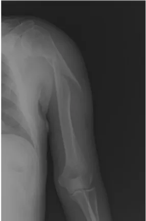 Fig. 4. Ação do músculo grande peitoral e da  coifa dos rotadores sobre o segmento proximal 