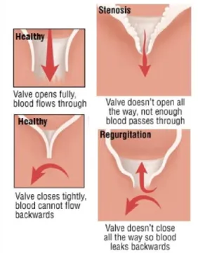 Figure  5 - Comparison between a healthy valve and valves with A ortic Valve Disease.   