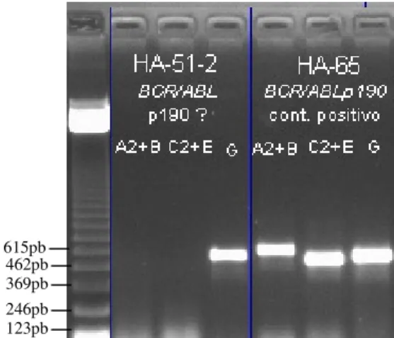 Figura  4.  Gel  de  agarose  1%  corado  com  brometo  de  etídio  evidenciando  RT-PCR  positivo para amplificação do transcrito do  rearranjo  E2A/PBX1  na  amostra  HA-33