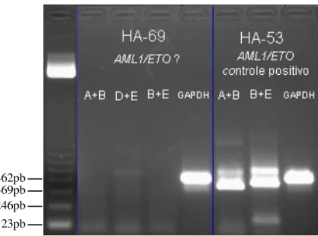 Figura 8. Gel de agarose 1% corado com brometo de  etídio  evidenciando  RT-PCR  positivo  para  amplificação do transcrito do rearranjo CBFB-MYH11  na amostra HA-58-2