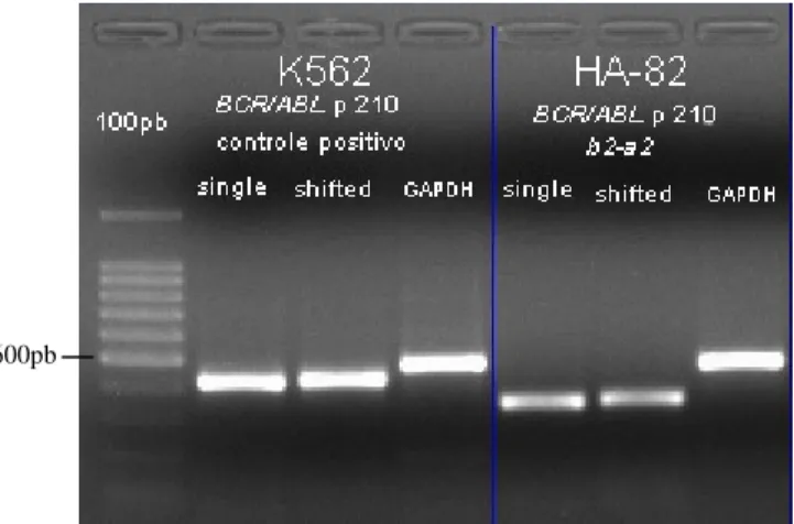 Figura 12.  Gel de agarose 1% corado com brometo  de  etídio  evidenciando  RT-PCR  positivo  para  amplificação  do  transcrito  do  rearranjo  BCR/ABL  major do tipo b3-a2 na amostra HA-77