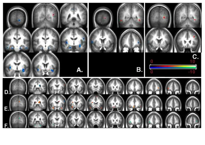 Fig. 2: Brain regions significantly higher activated in HC compared to OSA patients in cold  scheme; brain regions significantly higher activated in OSA patients as compared to HC in  warm color scheme
