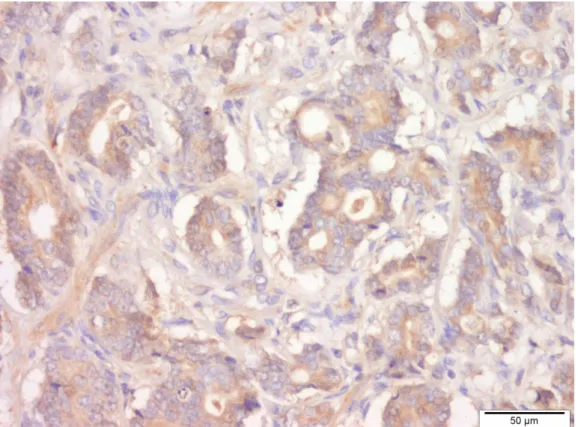 Figure 14. Immunohistochemical stain for TRBP protein expression in glands of prostate  adenocarcinoma