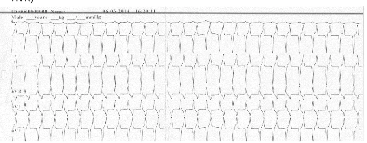 Figura 10. Extrassístole ventricular provocada por miocardite (Fonte: ECG facultado pelo  HVR) 