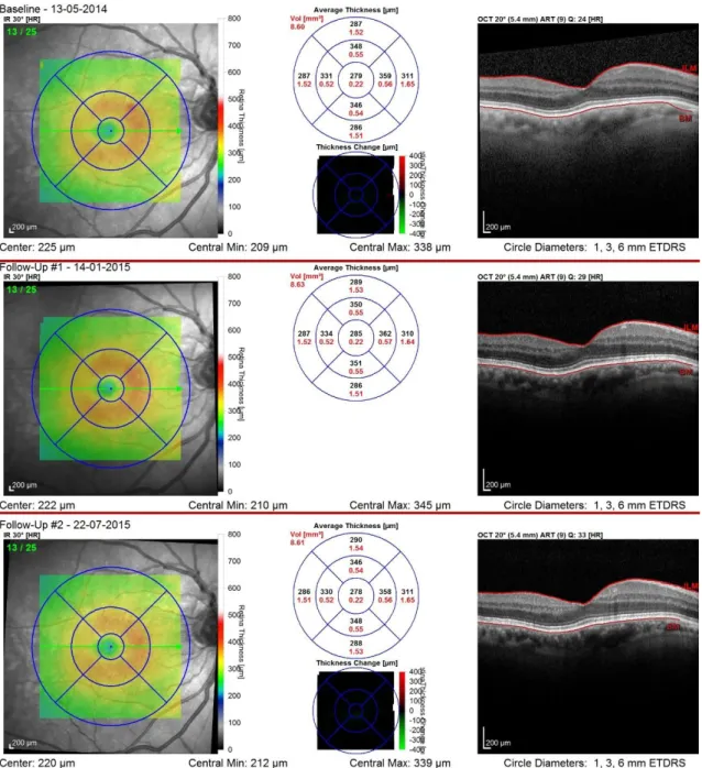 Figura 5 – OCT OD seriadas centradas na fóvea. Sem alterações significativas.  