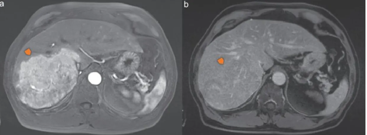 Figure 1 – Magnetic Resonance Imaging of  the “Wash out” phenomenum  in a patient  with  HCC  (adapted  from  Trojan  J,  Zangos  S,  Schnitzbauer  AA