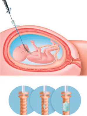 Figura 8.1: Oclus˜ao traqueal endosc´opica do feto, retirado de Deprest et al. [30] .