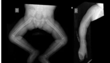 Figura 7: Radiografias ao esqueleto de  M.N.M. com osteopénia generalizada  