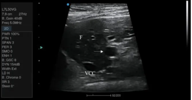 Figura 2. Imagem ultrassonográfica de exame transabdominal  do  fígado  de  caprino  Canindé  de  quatro  anos  de  idade