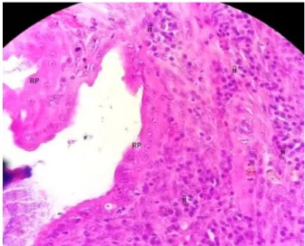 Figura  1.  Hiperplasia  de  glândulas  endometriais  difusa  moderada  com  reação  pseudoplacentacional  difusa  moderada  e  adenomiose  focal  discreta  (complexo hiperplasia endometrial cística tipo I -  seta);  M  –  região  medular