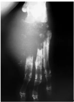 Figure  2.  Right  pelvic  limb  radiograph,  medial- medial-lateral  view:  periosteal  reaction  on  remaining  metatarsal  diaphysis