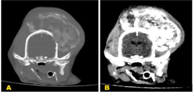 Figura 2. Imagem de reconstrução em plano sagital com filtro  para  (A)  tecido  ósseo  e  (B)  parênquima  cerebral,  evidenciando destruição óssea de ossos do crânio e  invasão  do  parênquima  cerebral  pela  massa  (seta  amarela)