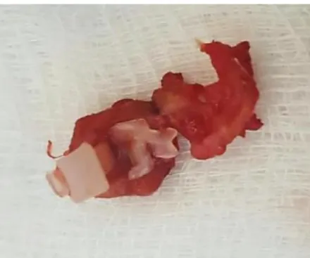 Figura  1.  Abraçadeira de  náilon  encontrada  dentro  do  granuloma  do  pedículo  ovariano  direito  de  uma cadela