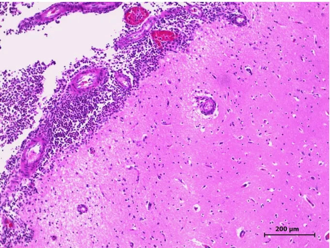 Figura 1  –  Deposição de fibrina e infiltrado neutrofílico nas leptomeninges e próximo  ao  hipocampo  em  um  ovino  com  meningite