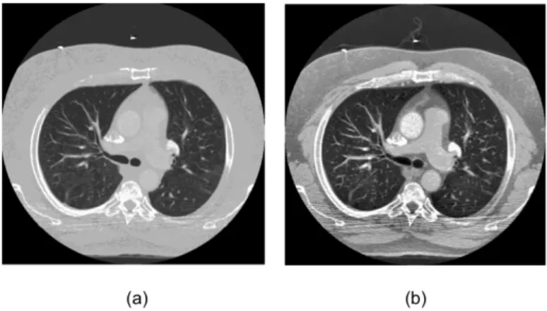 Figure 1: Example of an adaptive histogram-equalization of an image from LIDC-IDRI database: (a) is the original image and (b) is the equalized image.