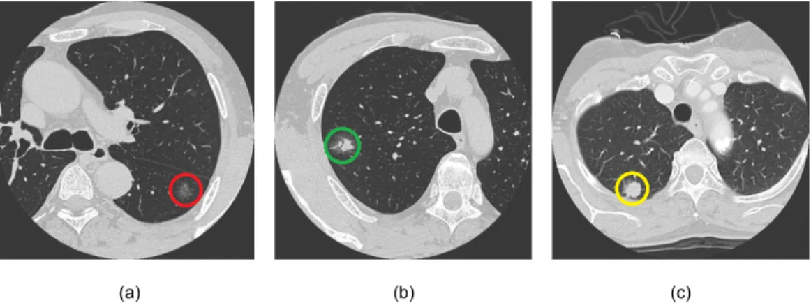 Figure 3: Lung CT image: (a) a non-solid nodule (red color), (b) a partially solid nodule (green color) and (c) a solid nodule (yellow color).