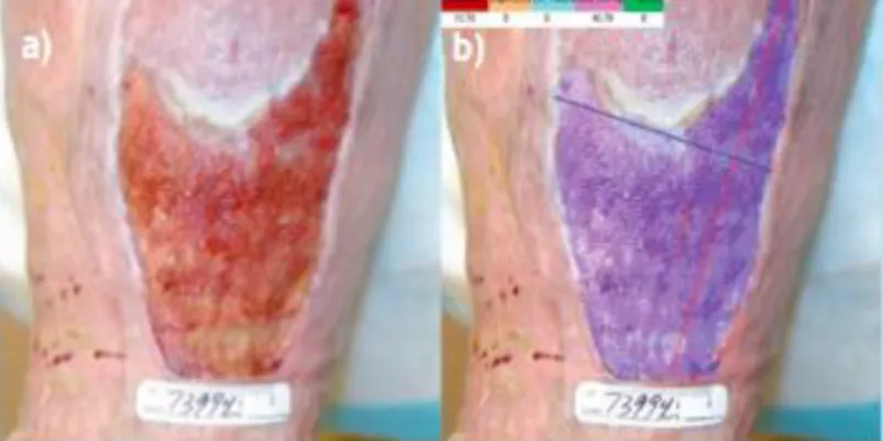 Figure 2.3- The ruler method a) Image of the wound b) Measurement of the length (red line) and width (blue  line) of the wound through the ruler method (Wendelken et al., 2011)
